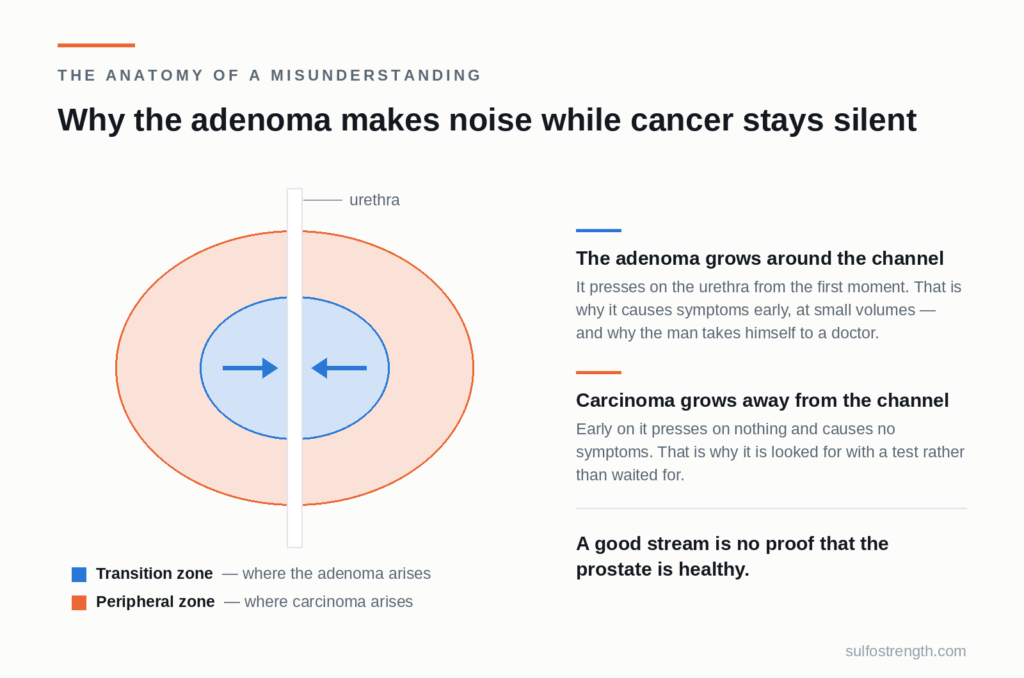Diagram of the prostate: the transition zone around the urethra, where the adenoma arises, and the peripheral zone, where carcinoma arises
