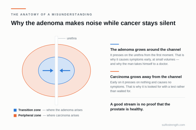 Diagram of the prostate: the transition zone around the urethra, where the adenoma arises, and the peripheral zone, where carcinoma arises