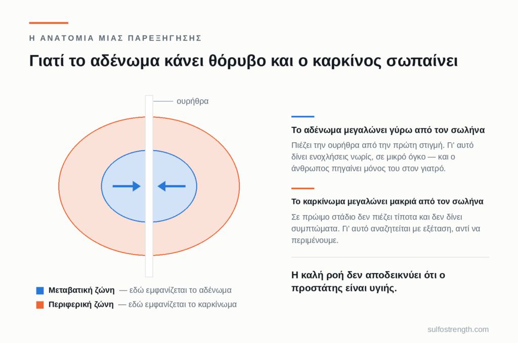 Σχήμα του προστάτη: η μεταβατική ζώνη γύρω από την ουρήθρα, όπου εμφανίζεται το αδένωμα, και η περιφερική ζώνη, όπου εμφανίζεται το καρκίνωμα